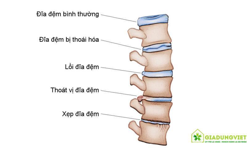 Thoái hóa cột sống thắt lưng: Nguyên nhân, triệu chứng và cách điều trị