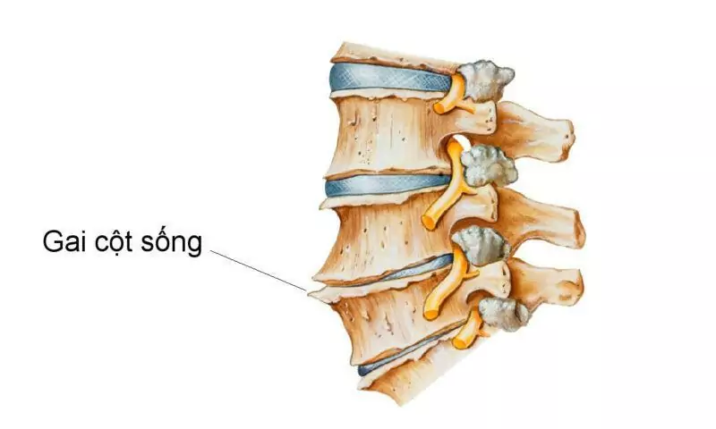 Gai cột sống