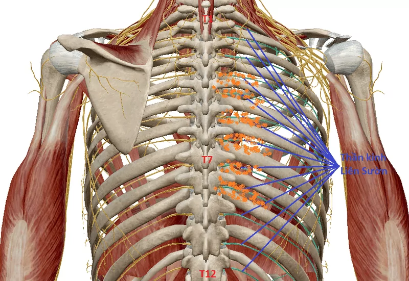 đau dây thần kinh liên sườn