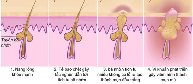 Co Che Hinh Thanh Cac Loai Mun 1