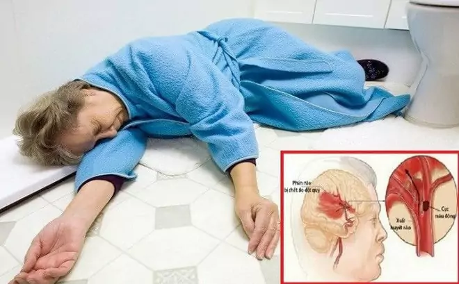 dấu hiệu đột quỵ