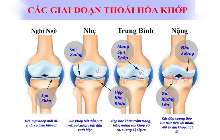0603 Cac Giai Doan Thoai Hoa Khop Goi Min