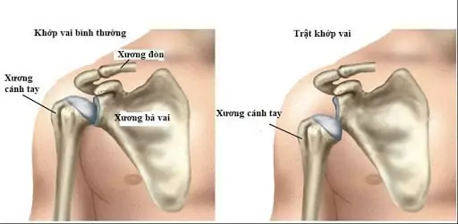Trat Khop Vai2 Min