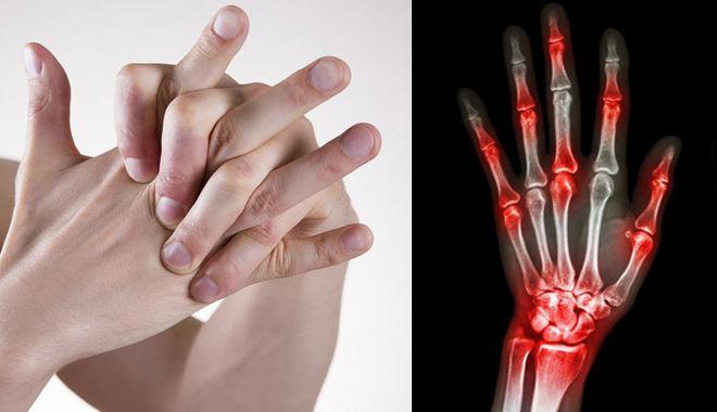ngón tay bị sưng đỏ, đau nhức có thể bắt nguồn từ bệnh gout