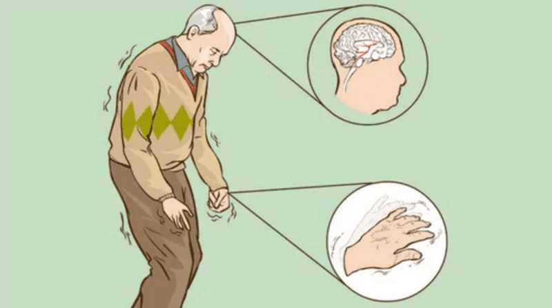 bệnh Parkinson là gì