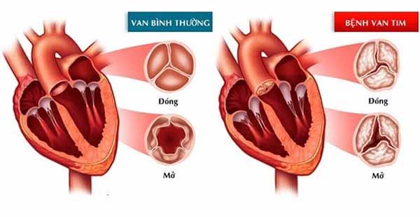 bệnh hở van tim