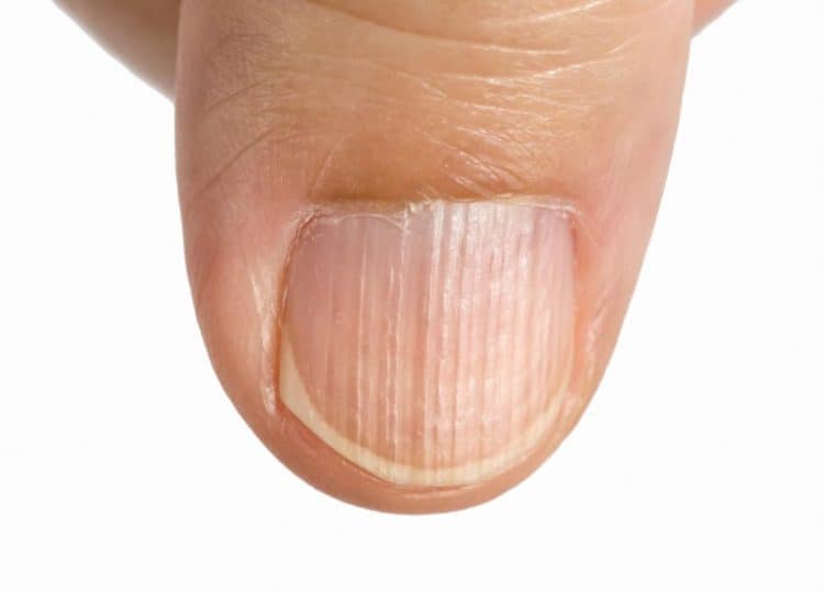 Bệnh lý móng tay: Không còn phải chấp nhận những bệnh lý móng tay khi bạn có thể tìm thấy giải pháp hiệu quả để chăm sóc móng tay của mình. Hãy xem hình ảnh để khám phá các cách giúp bạn vượt qua những vấn đề này và có được đôi tay đẹp như mong muốn.