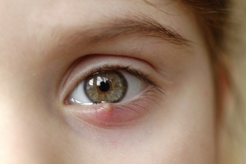 Close Up Of A Child's Eye Stye. Ophthalmic Hordeolum Disease.