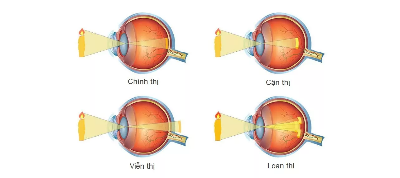 tác hại của điện thoại với mắt