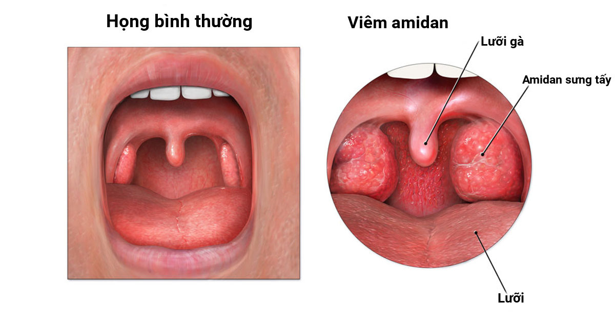 viêm amidan