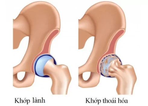 Thoai Hoa Khop Hang 1