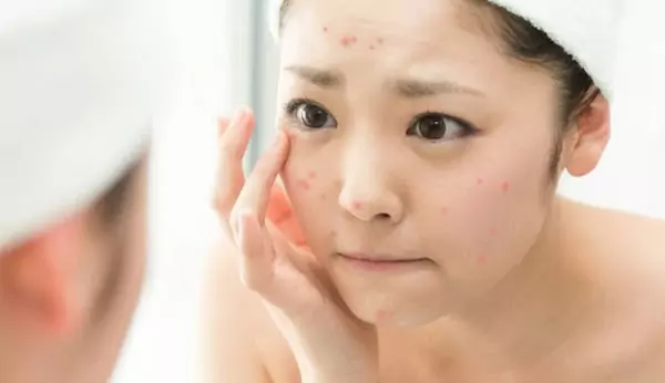 Dùng dầu dừa sẽ giúp bạn xóa mờ thâm 