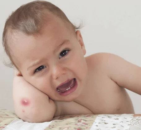 Các bệnh ngoài da thường gặp ở trẻ: Mụn nhọt