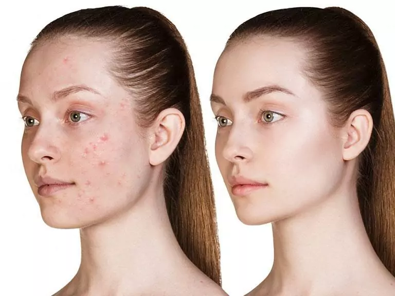 Các Bước Skincare Cho Da Mụn ẩn