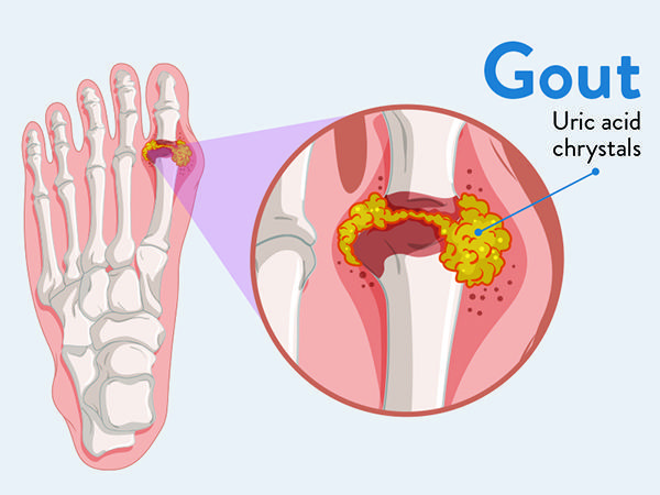 bệnh cơ xương khớp - bệnh gout