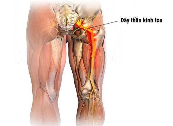 Bệnh đau dây thần kinh tọa và cách chữa trị dứt điểm