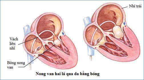 Bệnh Tim Mạch Nguy Hiểm Bệnh Van Tim Min