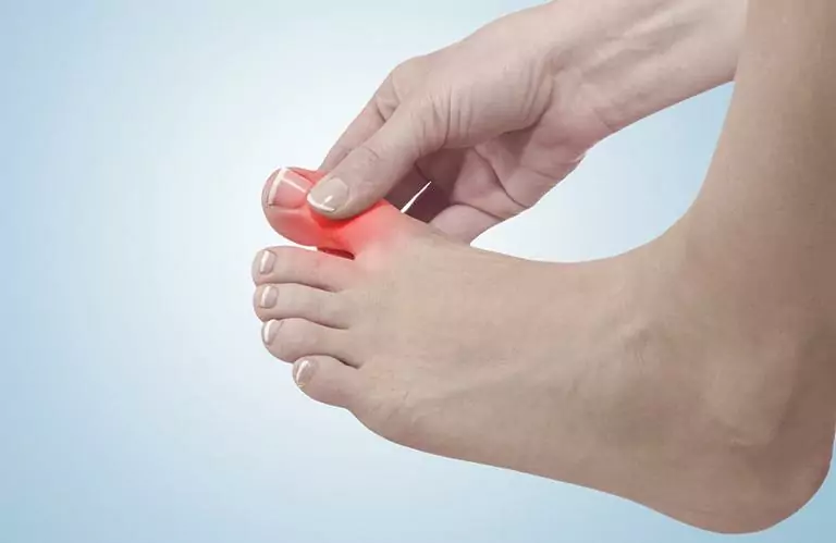 Bệnh gout