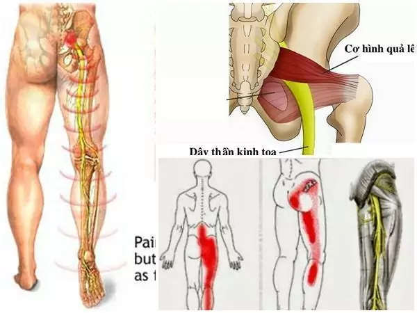 Đau dây thần kinh tọa