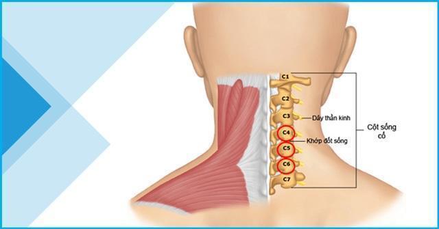 Thoát vị đĩa đệm cổ