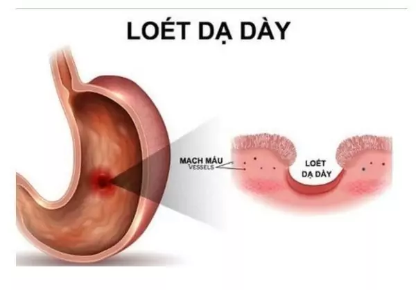 Đau vùng thượng vị lan ra sau lưng do loét dạ dày