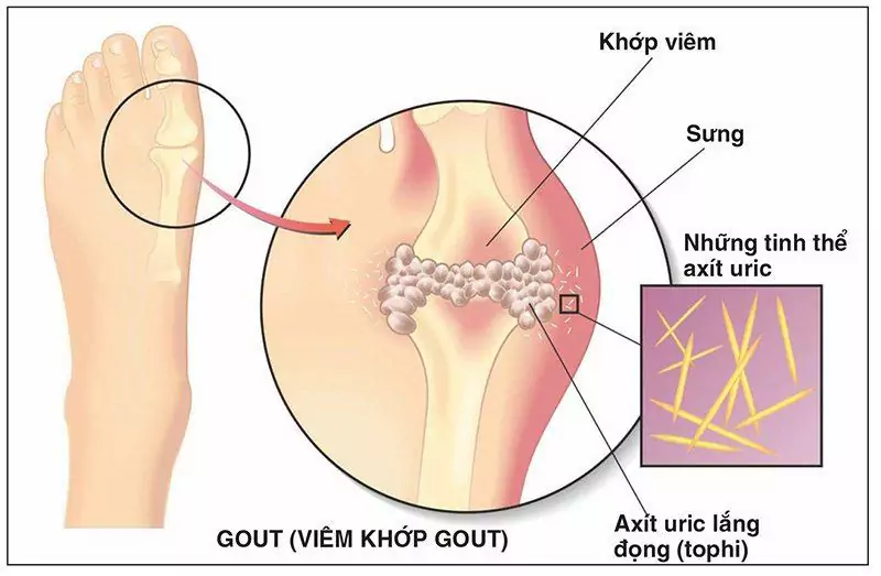 Kiến thức tổng quan về bệnh gút và cách phòng ngừa bệnh