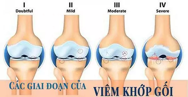 4 giai đoạn phát triển của bệnh viêm khớp gối