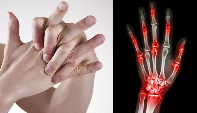Biến dạng ngón tay nếu bẻ khớp thường xuyên