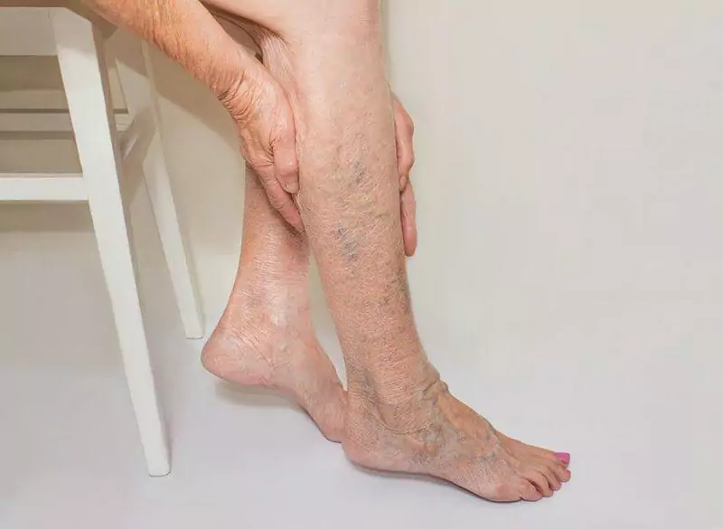 Tìm hiểu về bệnh suy giãn tĩnh mạch chân       