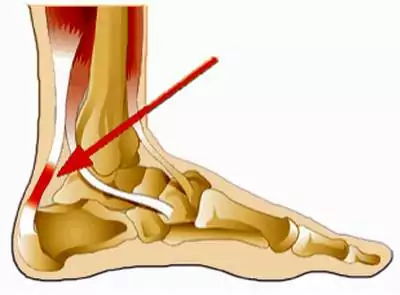 Tổng quan kiến thức về bệnh viêm gân